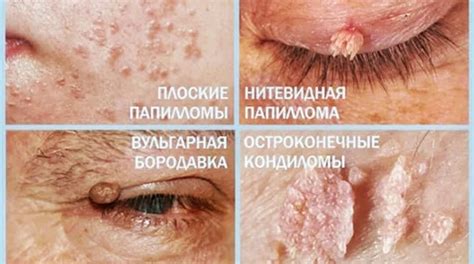 Папилломы: почему нужно избавляться?