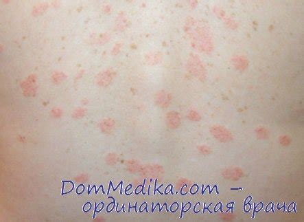 Розовый лишай - диагностика, лечение