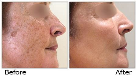 Sunspots On Face Treatment