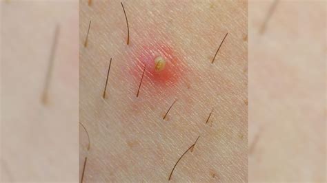 Ingrown Hair Cyst Groin