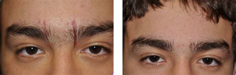 Skininfinity Laser & Aesthetics | Laser Hair Removal anywhere on the body.