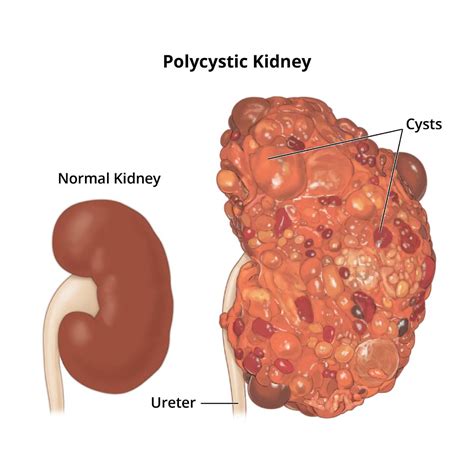 Polycystic Kidney Disease (PKD) - NIDDK