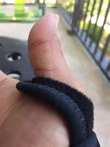 A pro (not really) tennis player needs a brace | Technology Feedback