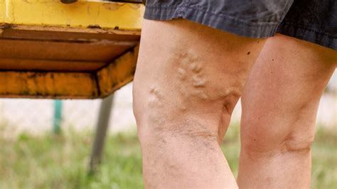 Varicose (spider) veins: Treatment, causes, symptoms, and more