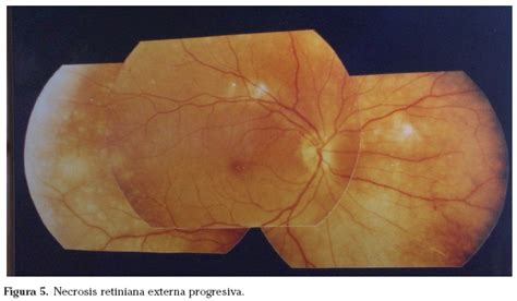 Sida y oftalmología: una visión actual