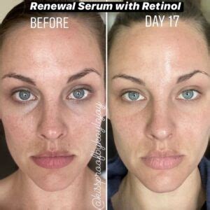 Retinol Before and After: Transform Your Skin with These Results - Must Read This Before Buying