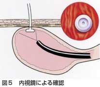 Chapter1 PEG 3.造設 1造設手技②Pull・Push法｜PDNレクチャー