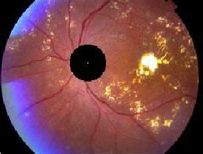 optic disc extracted image  scientific diagram