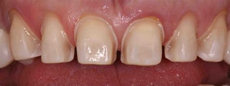 Anterior Veneer Prep for Closing Black Triangles - Lee Ann Brady, DMD's ...