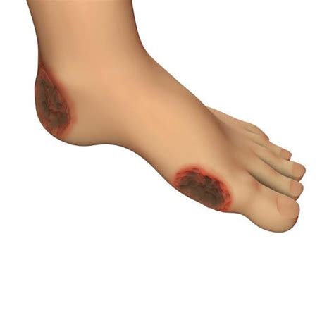 Foot Ulcers