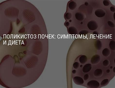 Поликистоз почек: симптомы, лечение, диета и народные средства при ...