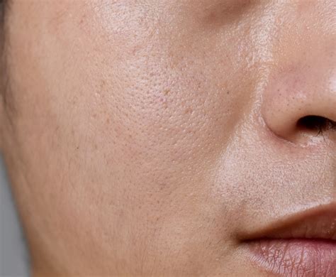 Почему расширяются поры, как с этим бороться?: как бороться с ...