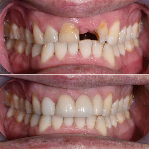 Patient Results - AllCare Beenleigh Dental