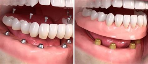 Prosthetic dentistry