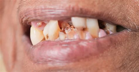 The Tooth, The whole Tooth and nothing but the Tooth | Average Joe Weekly