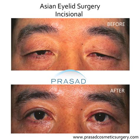 Upper Blepharoplasty / Upper Eyelid Surgery | Dr. Amiya Prasad