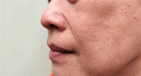 Pico Laser vs Traditional Laser Treatments: What's The Difference - SL ...