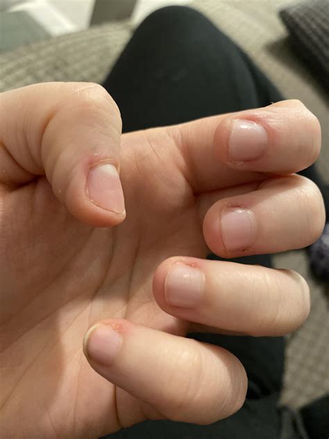 70 days I managed such long pretty nails but because of my stupid EDS