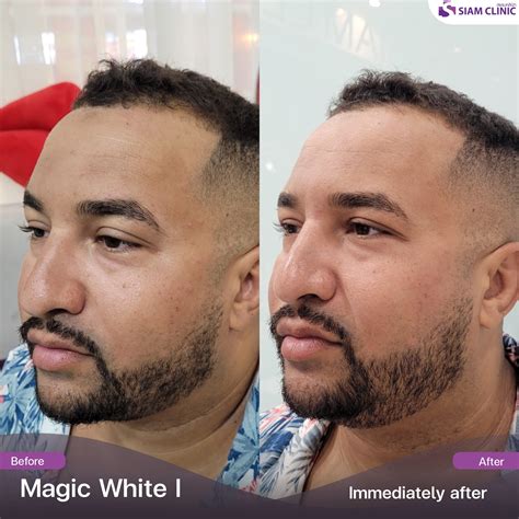 Brightening Treatment Before and After Photos - Siam Clinic Thailand
