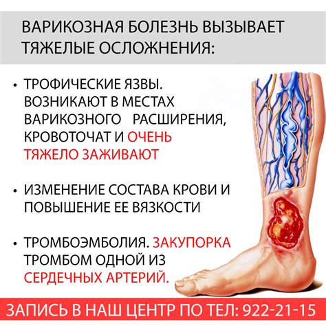 Чем опасна варикозная болезнь