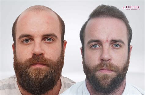 hair transplant results eugenix hair sciences