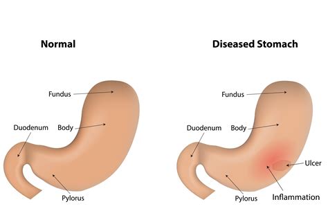 What Is The Difference Between Acute Gastritis And Chronic Gastritis