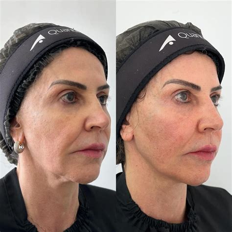 Liftera Antes E Depois - Fotos Antes e Depois | Liftera, Coolfase, Bioestimulador, Profhilo ...