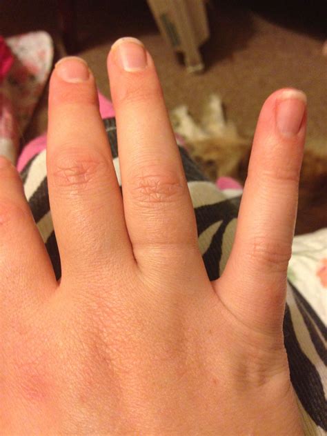 How to manage swollen fingers – Artofit