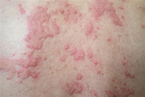 viral rash    hives  callum winter irving blog
