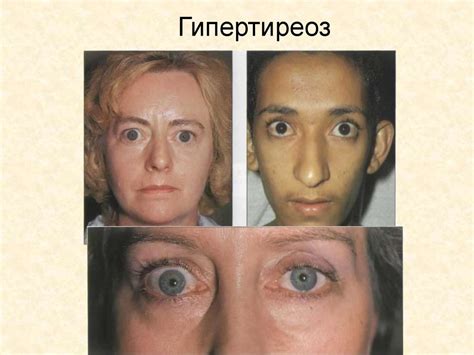 Гипертиреоз у мужчин: причины, симптомы и признаки, лечение