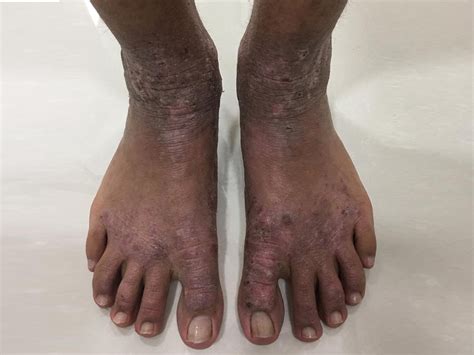 Dermatite Atópica No Pé - Dermatite De Contato Irritante Nos Pes