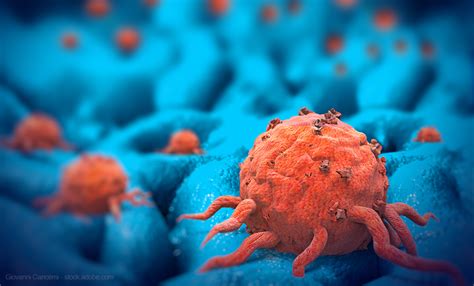 solid tumors  pharmacists