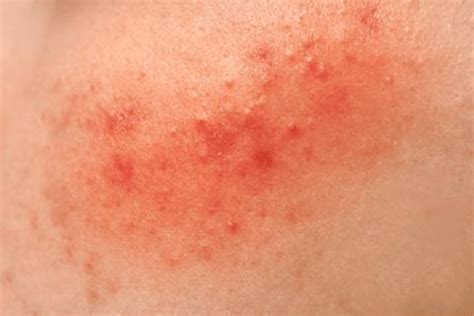 show common skin rashes mayo clinic common skin vrogueco