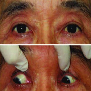 Ostiomeatal complex CT of the same patient. Axial (A) and coronal (B ...