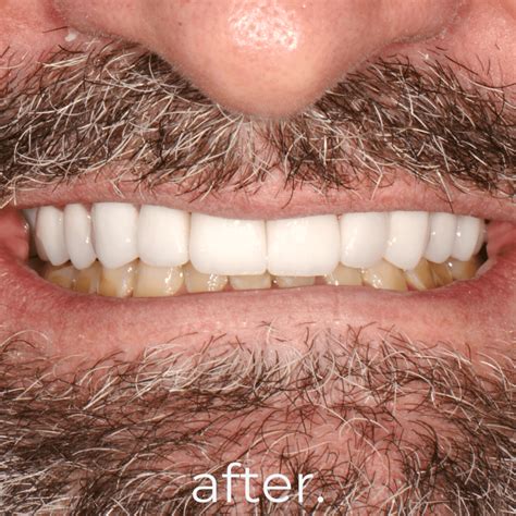 Professional & Trustworthy Bali Dentist - Fidelity Dental Bali