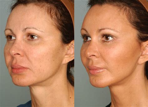 quarter view illustrates