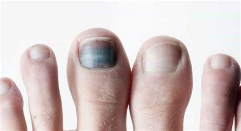 black spot   toenail    feet  clinic