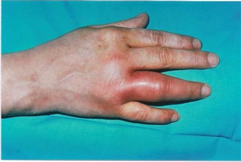 Gonococcal Arthritis - Symptoms, Diagnosis an Treatmetn | Bone and Spine