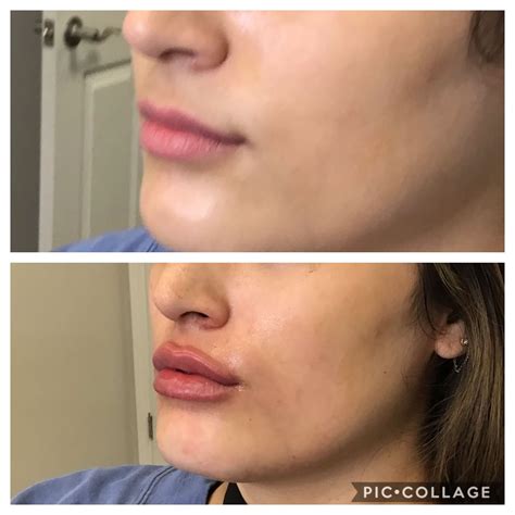 ba  rha  lip filler saintly skin