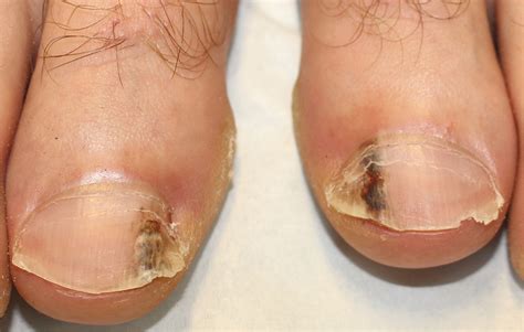 Bilateral tennis toe - Indian Journal of Dermatology, Venereology and ...