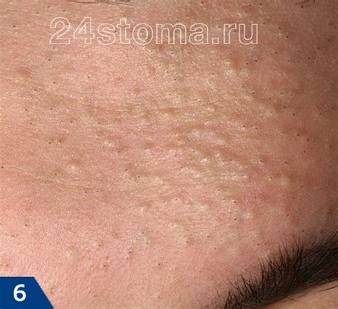 Вульгарные угри на лице (черные и белые) – как избавиться, препараты