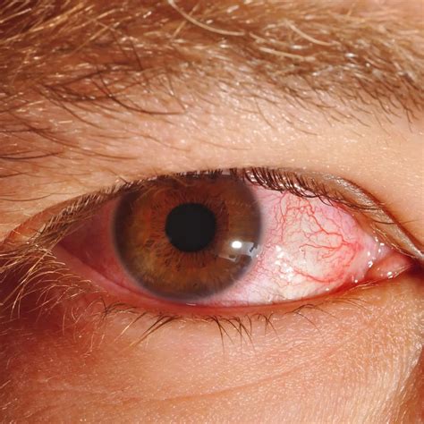 Eye Allergies Or Pink Eye Conjunctivitis? How To Tell - eyeFACTS