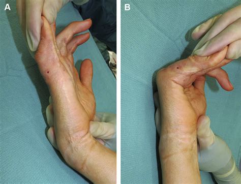 Dip Joint Contracture at Carolyn Cotter blog