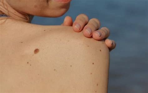 Рак на кожата – видове, лечения и първи признаци • lekuva.net