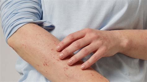 Co je atopický ekzém | Příčiny, příznaky a léčba | 5 praktických tipů