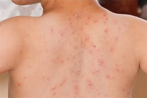 waspada campak jadi komplikasi sebabkan kematian pojok malioboro