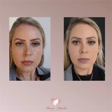 Fios Pdo Olheiras Antes E Depois
