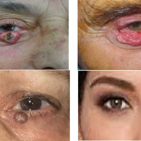 Photographs of right-eye nodual form eyelid BCC (up-left), right-eye ...