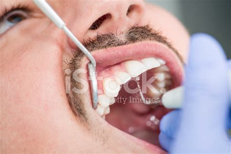 removing plaque stock photo royalty  freeimages