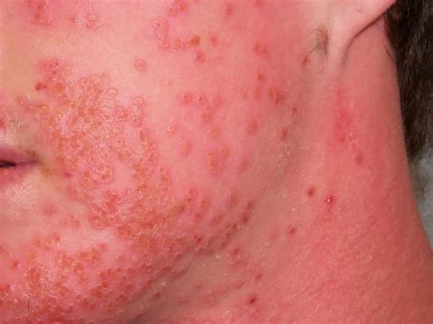 Staph Infection On Lips
